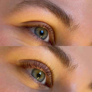 Microneedeling [1637426008342x943604131782459400]